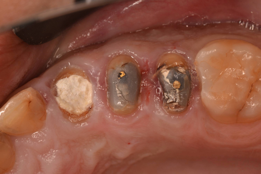 قبل تركيبات اسنان
